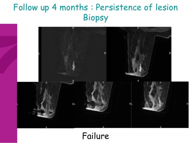 breast mri follow up Breast mri follow up
